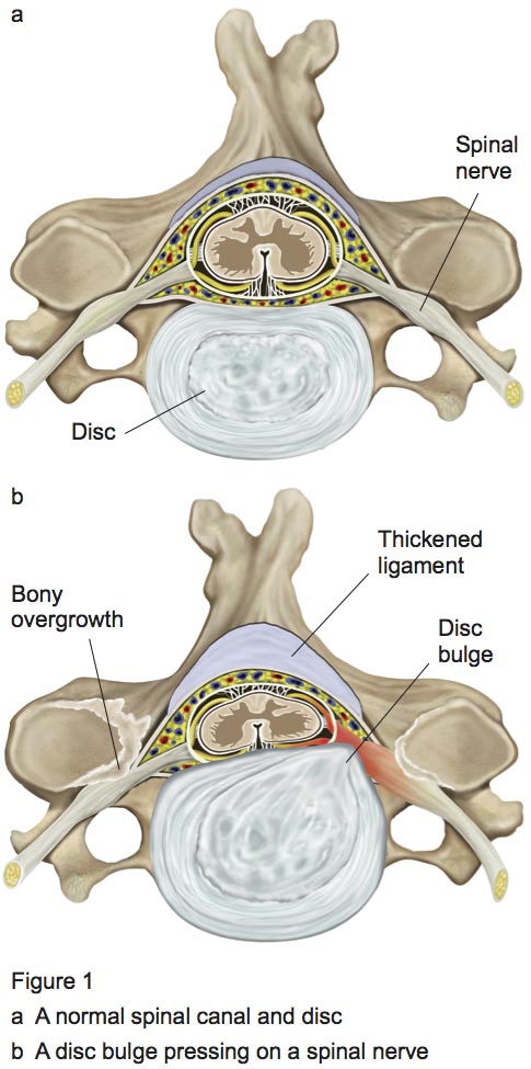 Is cervical laminectomy major surgery?